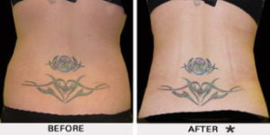 Safe Sculpt Before & After Image | Rejuvenation Center