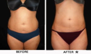 Safe Sculpt Before & After Image | Rejuvenation Center