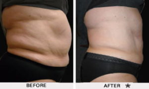 Safe Sculpt Before & After Image | Rejuvenation Center