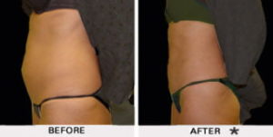 Safe Sculpt Before & After Image | Rejuvenation Center