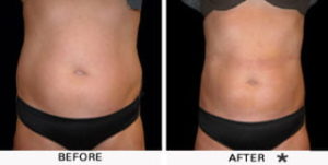 Safe Sculpt Before & After Image | Rejuvenation Center