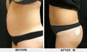 Safe Sculpt Before & After Image | Rejuvenation Center