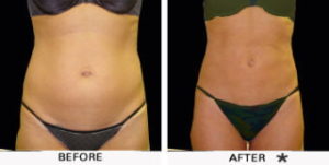 Safe Sculpt Before & After Image | Rejuvenation Center
