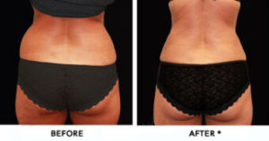 Safe Sculpt Before & After Image | Rejuvenation Center