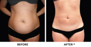 Safe Sculpt Before & After Image | Rejuvenation Center