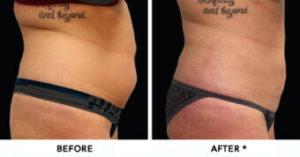Safe Sculpt Before & After Image | Rejuvenation Center