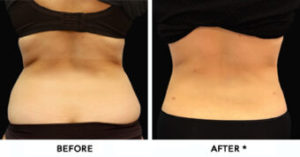 Safe Sculpt Before & After Image | Rejuvenation Center