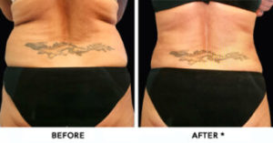 Safe Sculpt Before & After Image | Rejuvenation Center