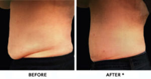 Safe Sculpt Before & After Image | Rejuvenation Center