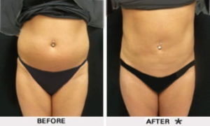 Safe Sculpt Before & After Image | Rejuvenation Center