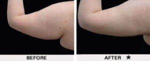Safe Sculpt Before & After Image | Rejuvenation Center