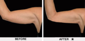 Safe Sculpt Before & After Image | Rejuvenation Center