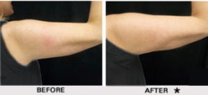 Safe Sculpt Before & After Image | Rejuvenation Center