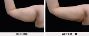 Safe Sculpt Before & After Image | Rejuvenation Center