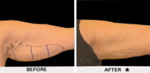 Safe Sculpt Before & After Image | Rejuvenation Center