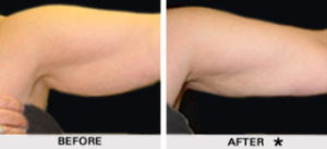 Safe Sculpt Before & After Image | Rejuvenation Center