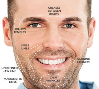 Dermal-Fillers For Men | Rejuvenation-Center
