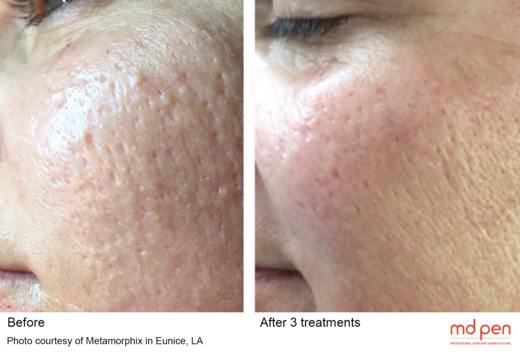 MicroNeedling Before & After Image | Rejuvenation Center | Wheeling, WV