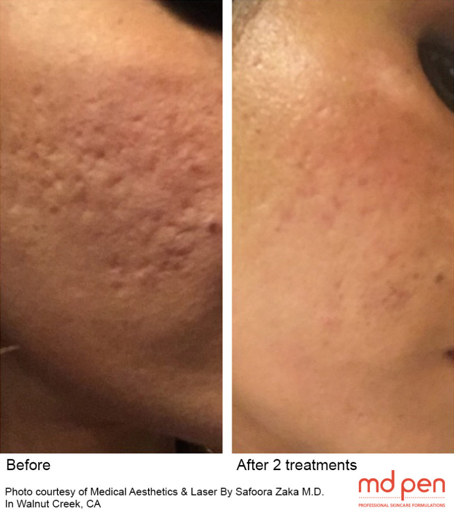 MicroNeedling Before & After Image | Rejuvenation Center | Wheeling, WV
