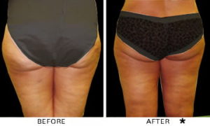 Safe Sculpt Before & After Image | Rejuvenation Center