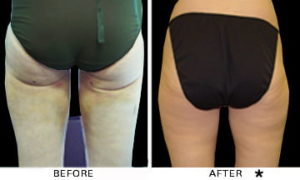 Safe Sculpt Before & After Image | Rejuvenation Center