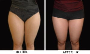 Safe Sculpt Before & After Image | Rejuvenation Center