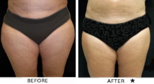 Safe Sculpt Before & After Image | Rejuvenation Center