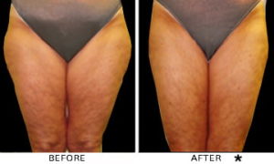 Safe Sculpt Before & After Image | Rejuvenation Center