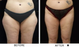 Safe Sculpt Before & After Image | Rejuvenation Center