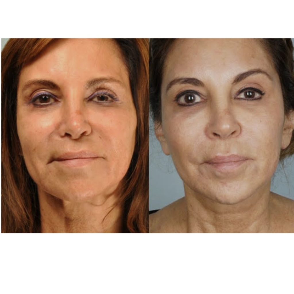 VivaceRF Before & After | Rejuvenation Center | Wheeling, WV