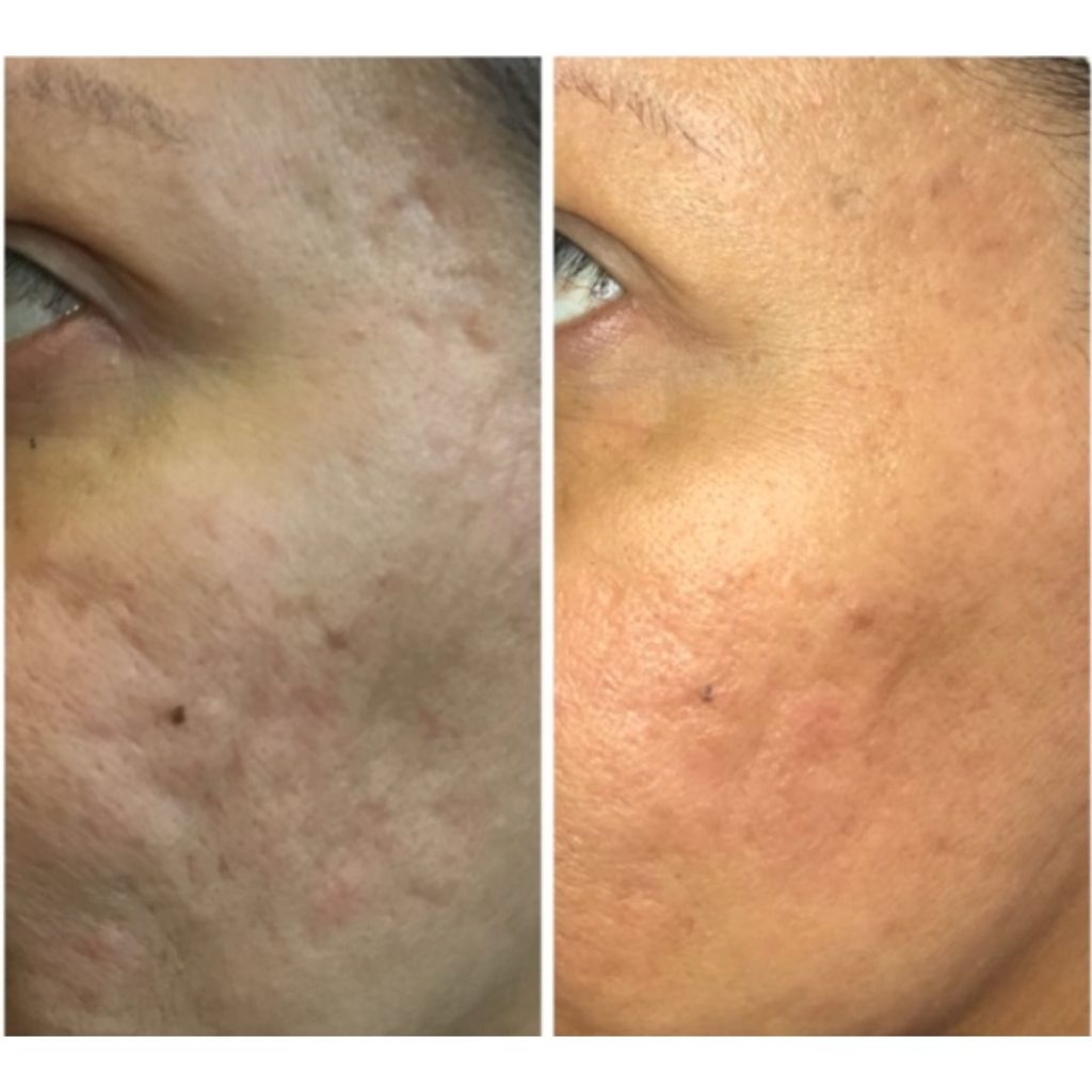 VivaceRF Before & After | Rejuvenation Center | Wheeling, WV