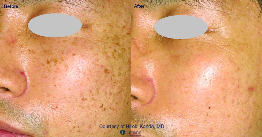 Photo Facial Rejuvenation | Rejuvenation Center | Wheeling, WV