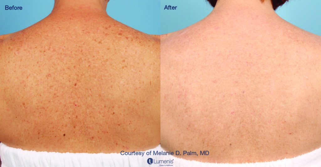 Tattoo Removal Before & After Image | Rejuvenation Center