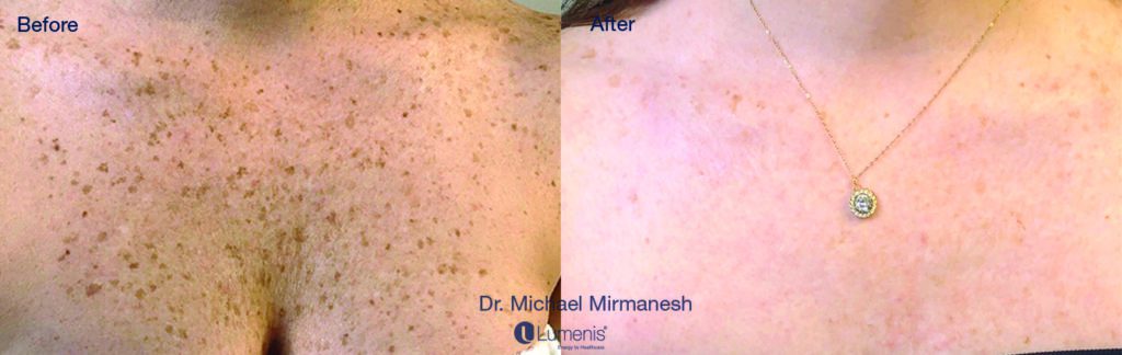 Photo Facial Rejuvenation | Rejuvenation Center | Wheeling, WV