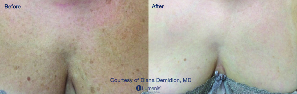 Photo Facial Rejuvenation | Wheeling, WV