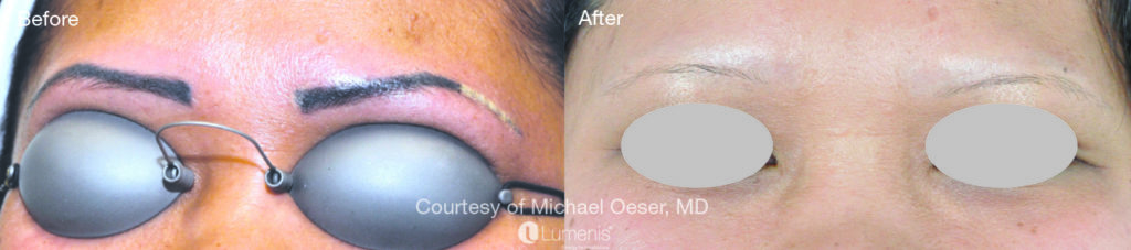 Tattoo Removal Before & After Image | Rejuvenation Center