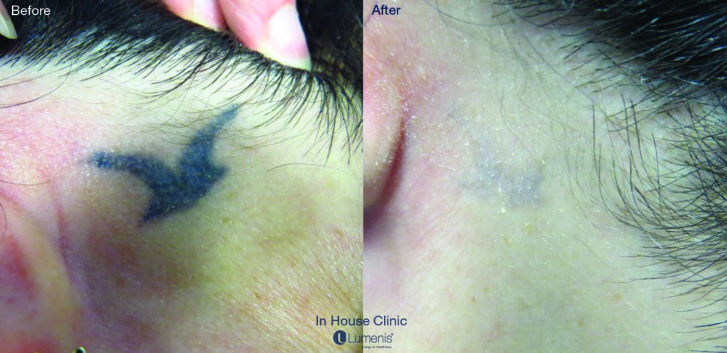 Tattoo Removal Before & After Image | Rejuvenation Center