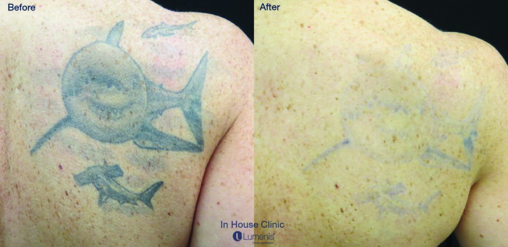 Tattoo Removal Before & After Image | Rejuvenation Center