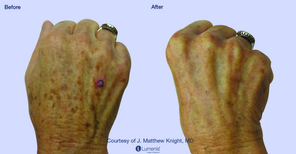 Photorejuvenation 19
