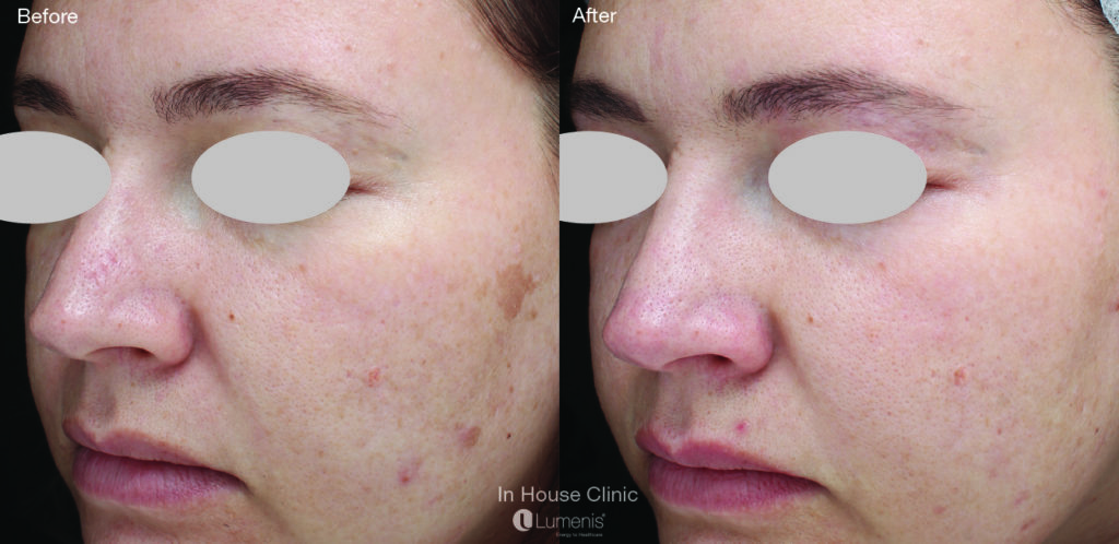 Pigmentation 66