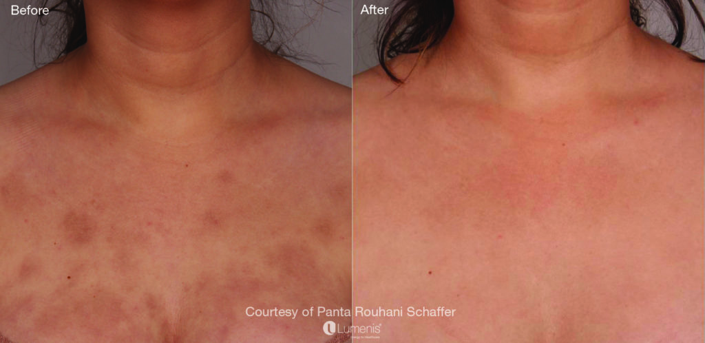 Pigmentation 67