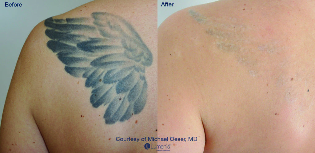Tattoo Removal 74