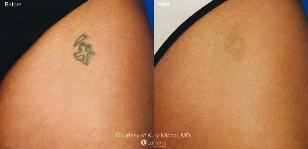 Tattoo Removal 77