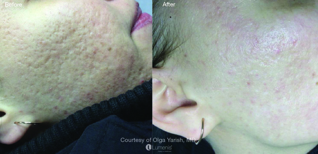 Textural Treatment acnescars