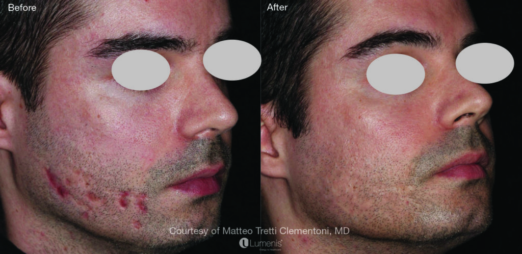 Textural Treatment scar2