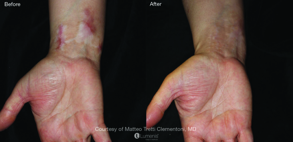 Textural Treatment scar3