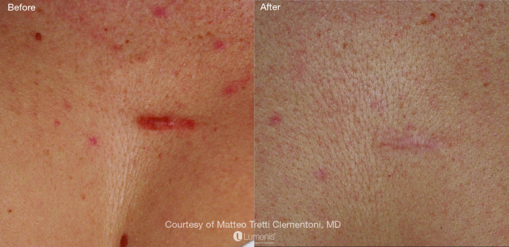 Textural Treatment scar4