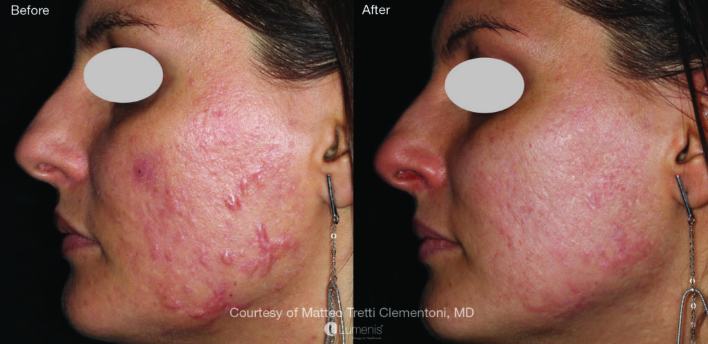 Textural Treatment scarz