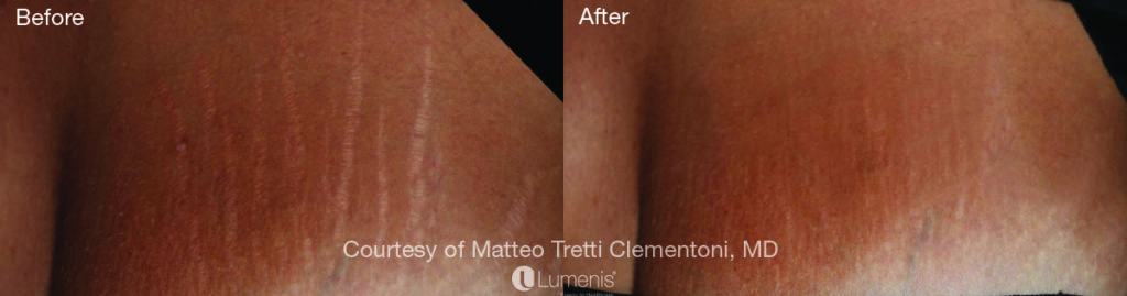 Textural Treatment smarks