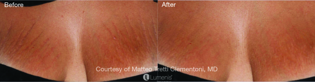 Textural Treatment stretch